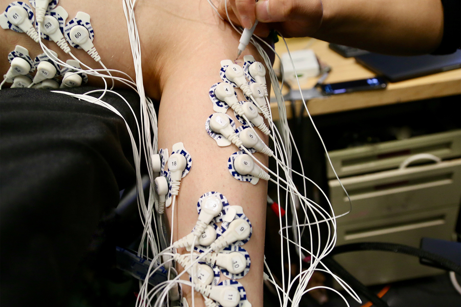 Researchers Say New Surgery Improves Prostheses Control
